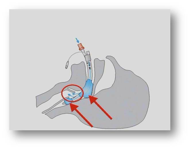 Funktionsweise des Larynxtubus larynx.jpg